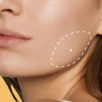 Masseter Botox