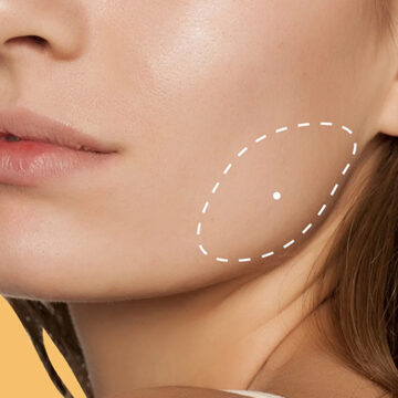 kliniek-144 Masseter Botox