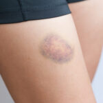 Spontane blauwe plekken