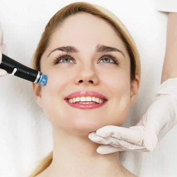 Microneedling