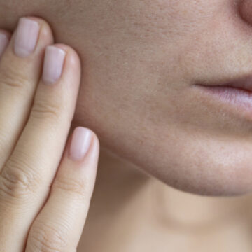 kliniek-284 Droge huid