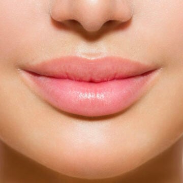 Lip fillers Amsterdam