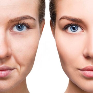 Sculptra Amsterdam