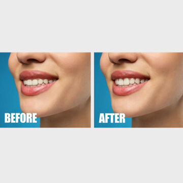 kliniek-332 Botox gummy smile