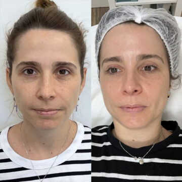 Microneedling voor en na