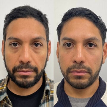 Fillers: voor en na