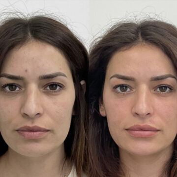 Botox: voor en na