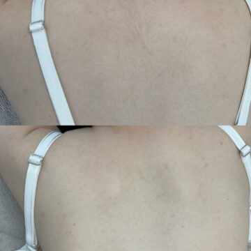 kliniek-347 Laser ontharen: voor en na
