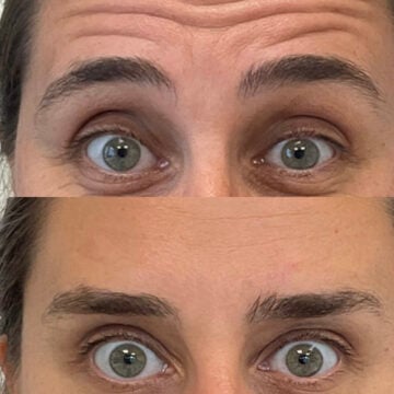 kliniek-348 Botox Amsterdam