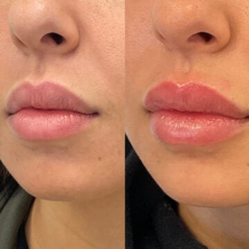 Lip fillers Amsterdam