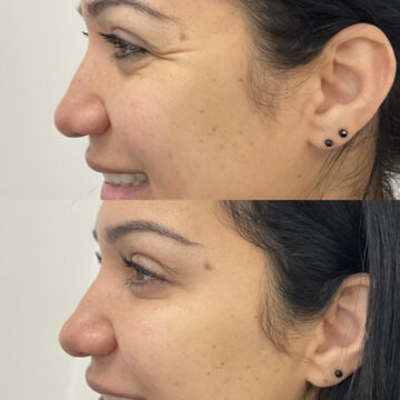 Botox kraaienpootjes