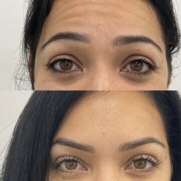 Rimpels voorhoofd botox