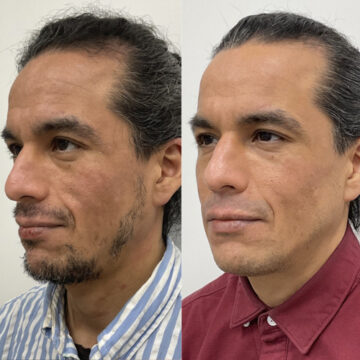 Fillers: voor en na
