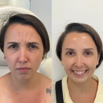 kliniek-353 Botox Amsterdam