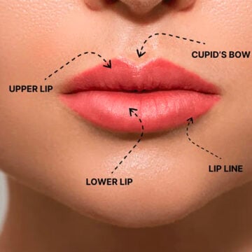 kliniek-368 Cupid’s bow lip filler
