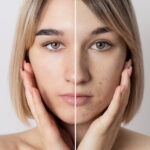 Microneedling gezicht