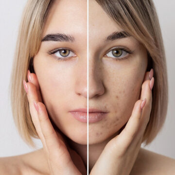 kliniek-417 Microneedling gezicht