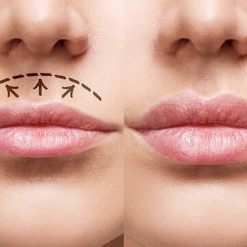 kliniek-420 Lip lift Amsterdam